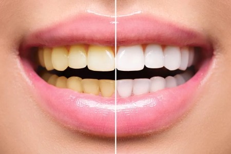 Best Teeth Whitening Clinics in India for Sensitive Teeth