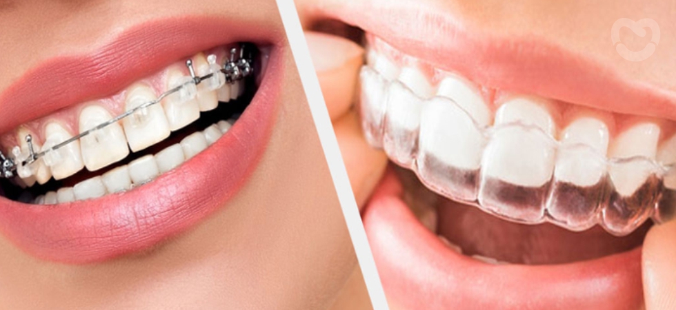 Braces vs Clear Aligners