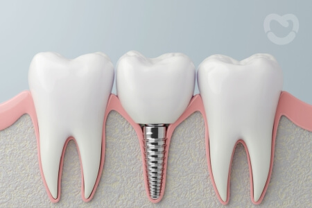 Dental implants vs bridges