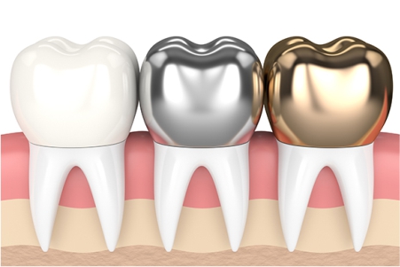 Dental Crowns
