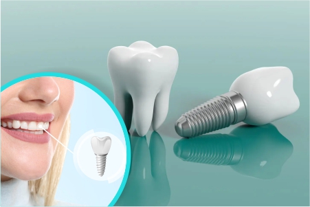 How Safe Are Dental Implants? A Complete Guide