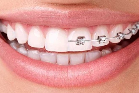 Invisalign vs Traditional Braces: Which Is Better for Teens