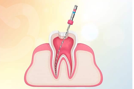 Root Canal vs Tooth Extraction in India: Cost, Pain, Recovery, and Long-Term Impact