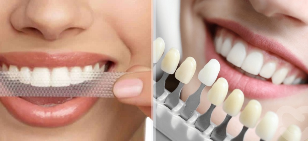 Teeth Whitening Strips vs Professional Whitening