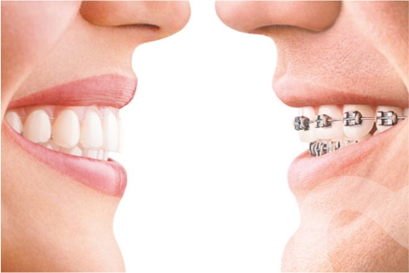 Best Teeth Straightening Method
