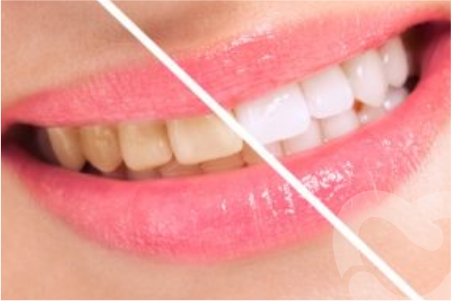 Professional Teeth Whitening Method