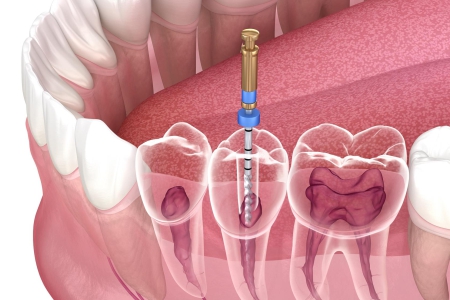 Understanding the role of endodontists