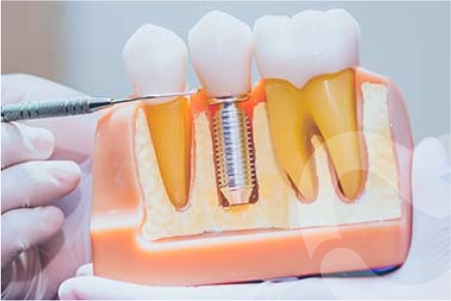 Understanding Root Canal Treatment